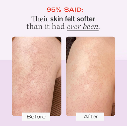 First Aid Beauty - KP Bump Eraser Body Scrub